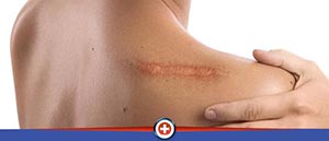 Stitches for Lacerations Near Me in Cincinnati, OH 
