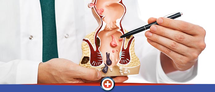Thrombosed Hemorrhoids Treatment Near Me in Cincinnati, OH 
