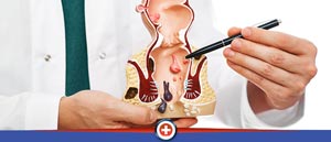Thrombosed Hemorrhoids Treatment Near Me in Cincinnati, OH 
