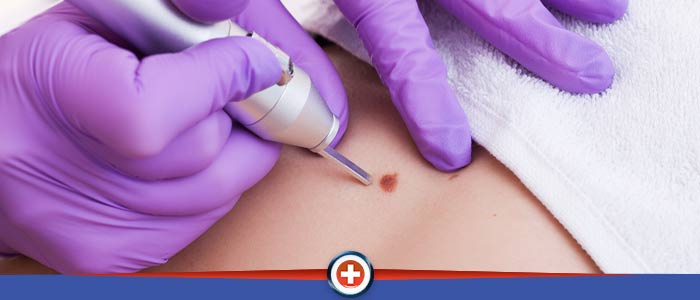 Removal of Sebaceous Cysts and Benign Skin Lesions Near Me in Cincinnati OH 
