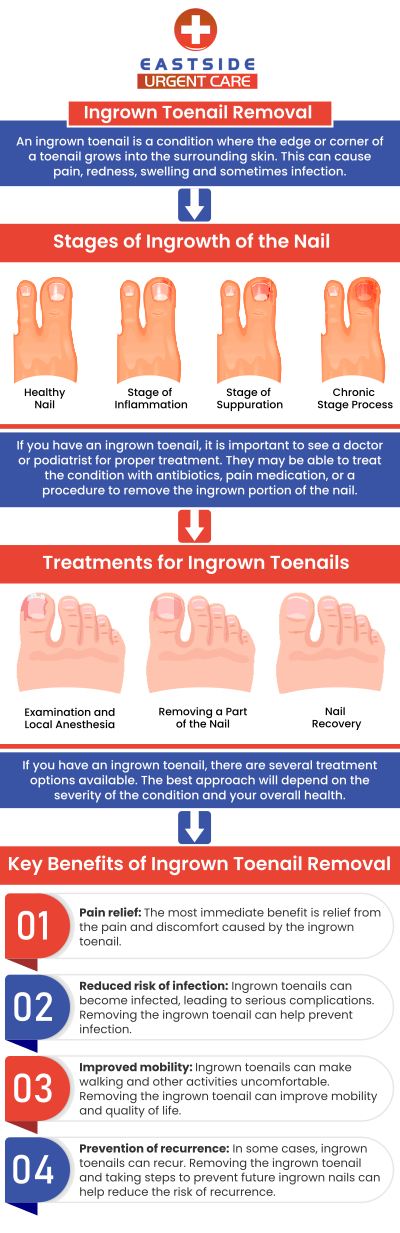 An ingrown nail happens when the nail grows into the skin or when the skin on one or both sides of the nail grows over the nail's edges. An ingrown toenail may initially be painful, large, and rigid. Later on, it could feel really painful and get red and infected. Ingrown toenail removal treatment is available at Eastside Urgent Care. For more information, contact us or book an appointment. You can also visit us online to get directions to our clinic. We are conveniently located at 988 Ohio Pike, Cincinnati, OH 45245.